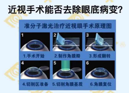 近視手術(shù)能否去除眼底病變？