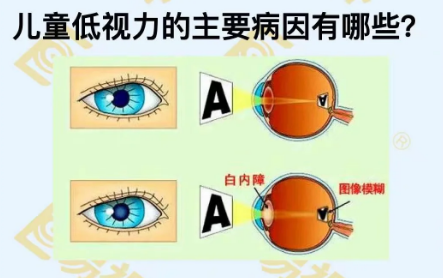 兒童低視力主要病因有哪些？