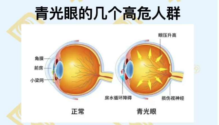 青光眼的幾個(gè)高危人群？