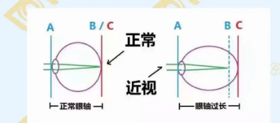 哪個年齡近視度數(shù)最容易增長？